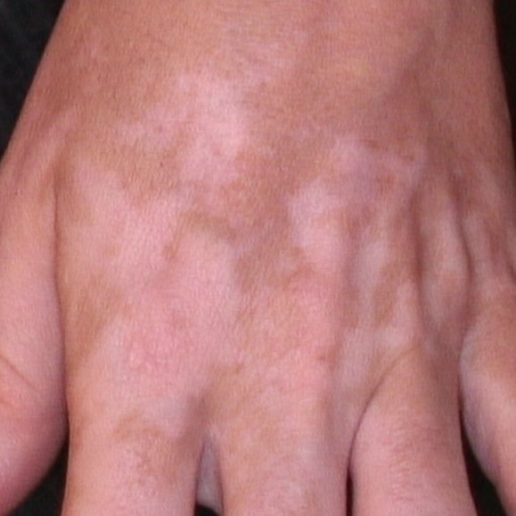 Kombination af carboxyterapi med smalbånds-ultraviolet B i behandlingen af genstridige områder af vitiligo: Et randomiseret klinisk forsøg