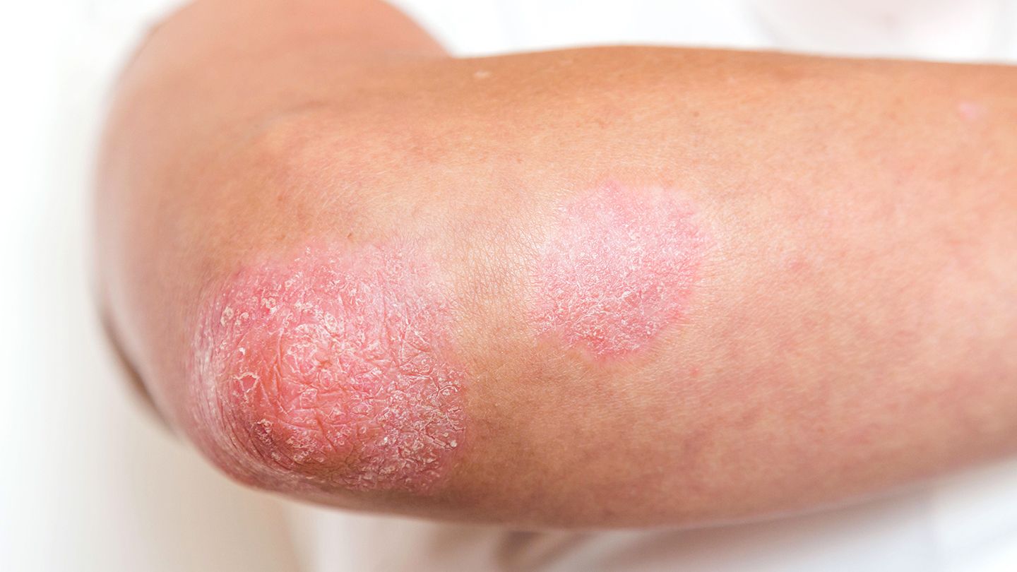 Konklusion: NB-UVB er en effektiv behandling af psoriasis - november 2021 forskning